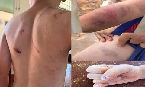 Bé trai kể giây phút bị bố và bà nội đánh đập dã man