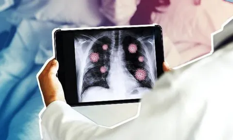 Viêm phổi COVID-19, triệu chứng và những điều cần biết