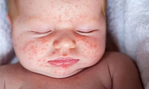 Triệu chứng lạ của trẻ nhỏ nhiễm biến thể Omicron