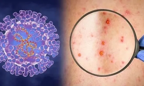 WHO: Bệnh đậu mùa khỉ không gây nguy cơ nghiêm trọng đối với y tế toàn cầu