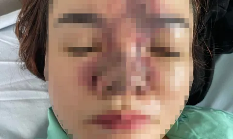 Tai biến thẩm mỹ khi đến spa làm đẹp, một phụ nữ bị hoại tử toàn bộ da mũi