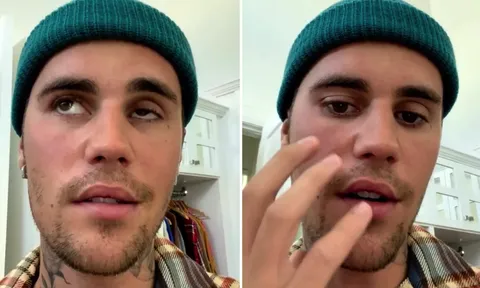 Hội chứng Ramsay Hunt khiến Justin Bieber liệt nửa mặt là gì?