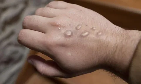 WHO chuẩn bị họp khẩn, bệnh đậu mùa khỉ xuất hiện liên tiếp ở 2 quốc gia châu Á