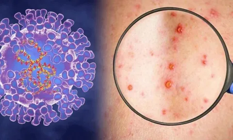 Phát hiện triệu chứng mới của người mắc bệnh đậu mùa khỉ