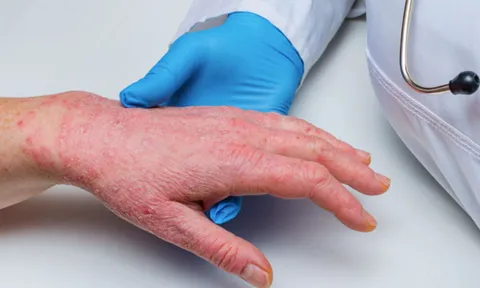 Lý do WHO kêu gọi đổi tên bệnh đậu mùa khỉ