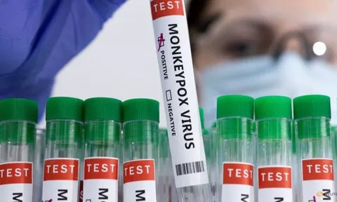 Info: Phân biệt đậu mùa khỉ và thủy đậu