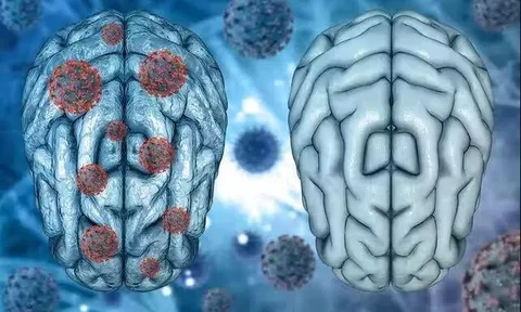 Covid-19 có thể gây viêm não tương tự bệnh Parkinson